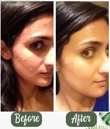 Allerged before and after photo of Reetata Green Tea Mask