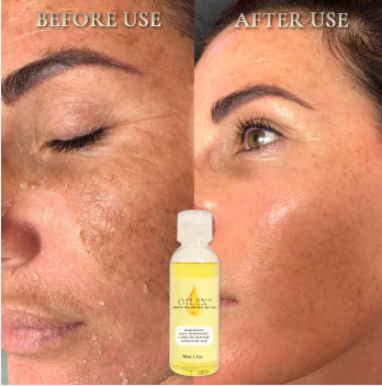Oilex yellow peeling oil before and after